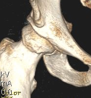 Hip CAM CT 1